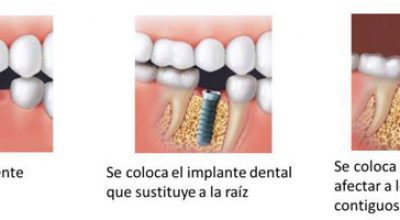 implantes2.jpg